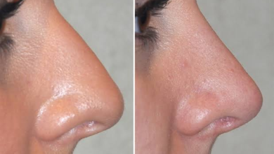 عمليات تجميل الأنف